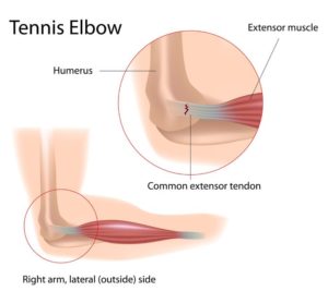 tennis_elbow