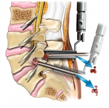minimally_invasive_discectomy_small Lumbar Discectomy