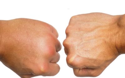 PHYSICAL THERAPY TREATMENT FOR EDEMA OR EFFUSION